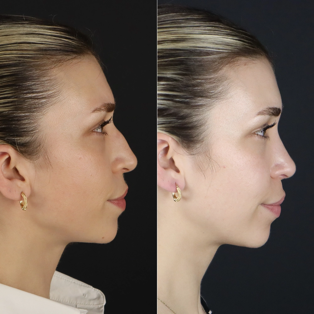 before after10