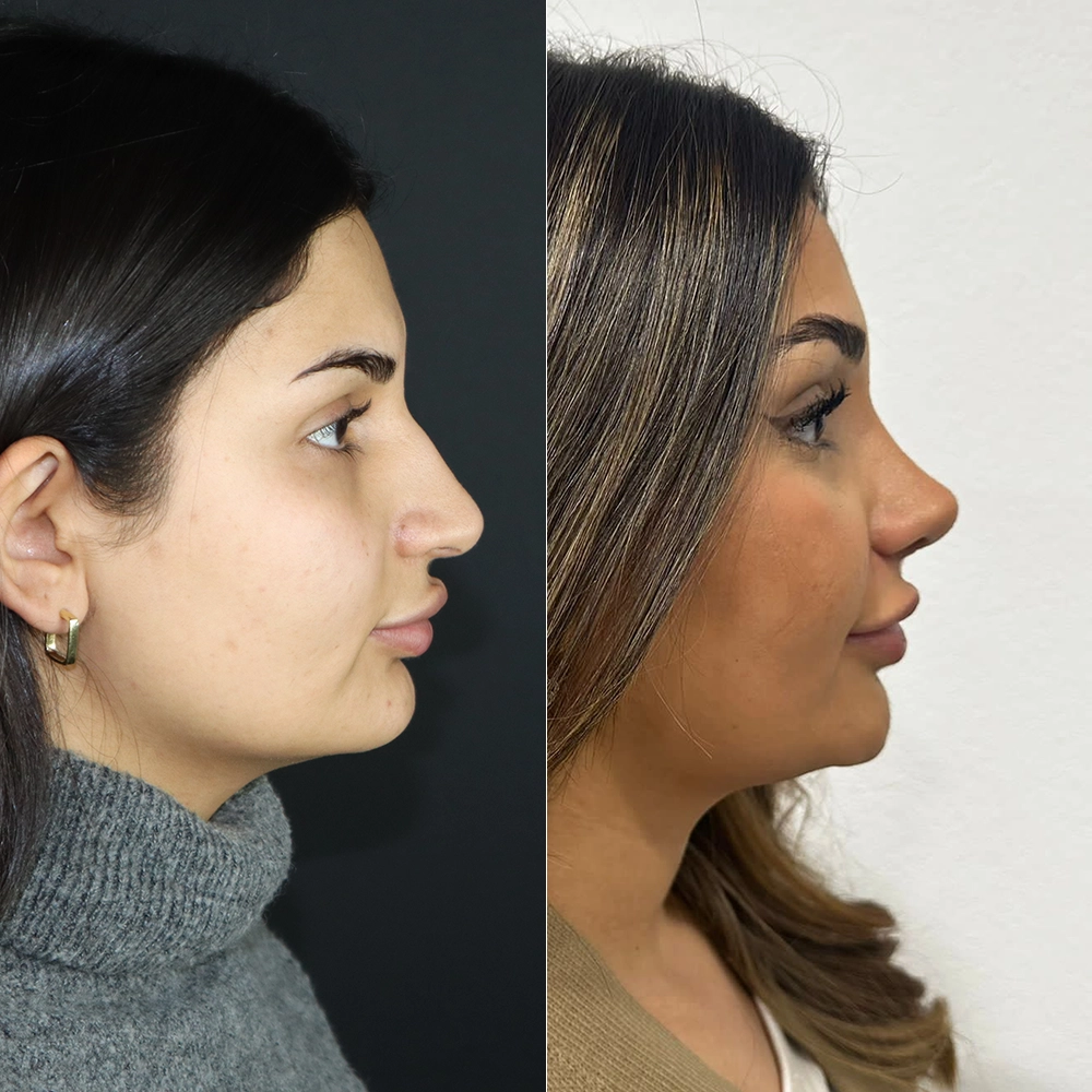 before after11