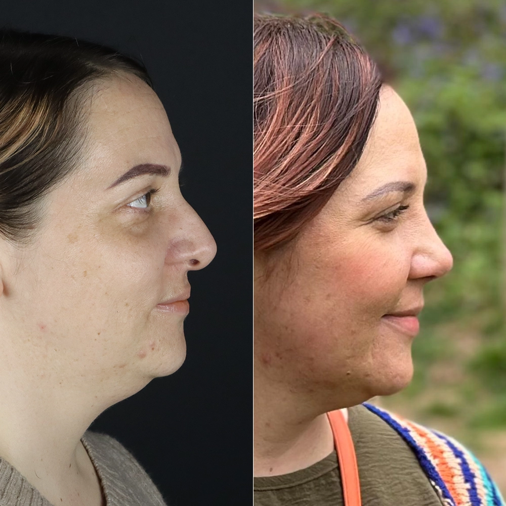before after12