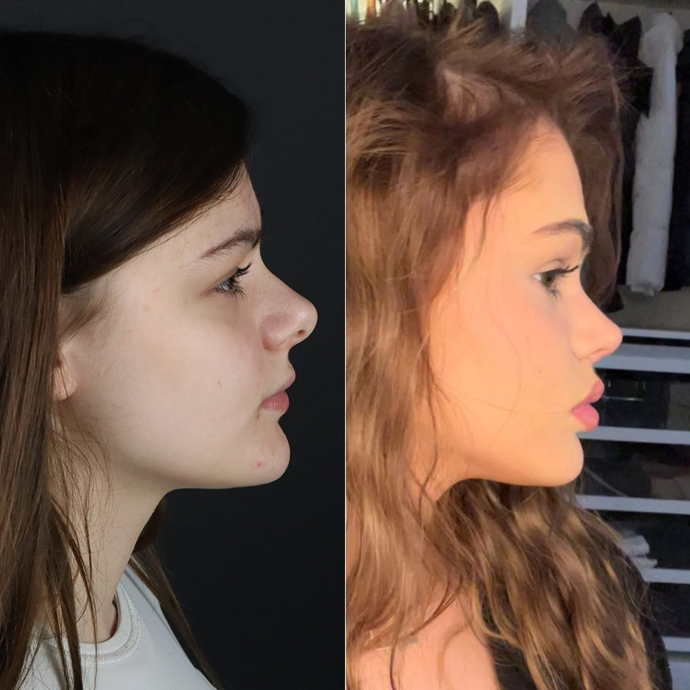before after2