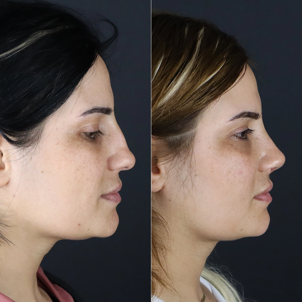 before after4