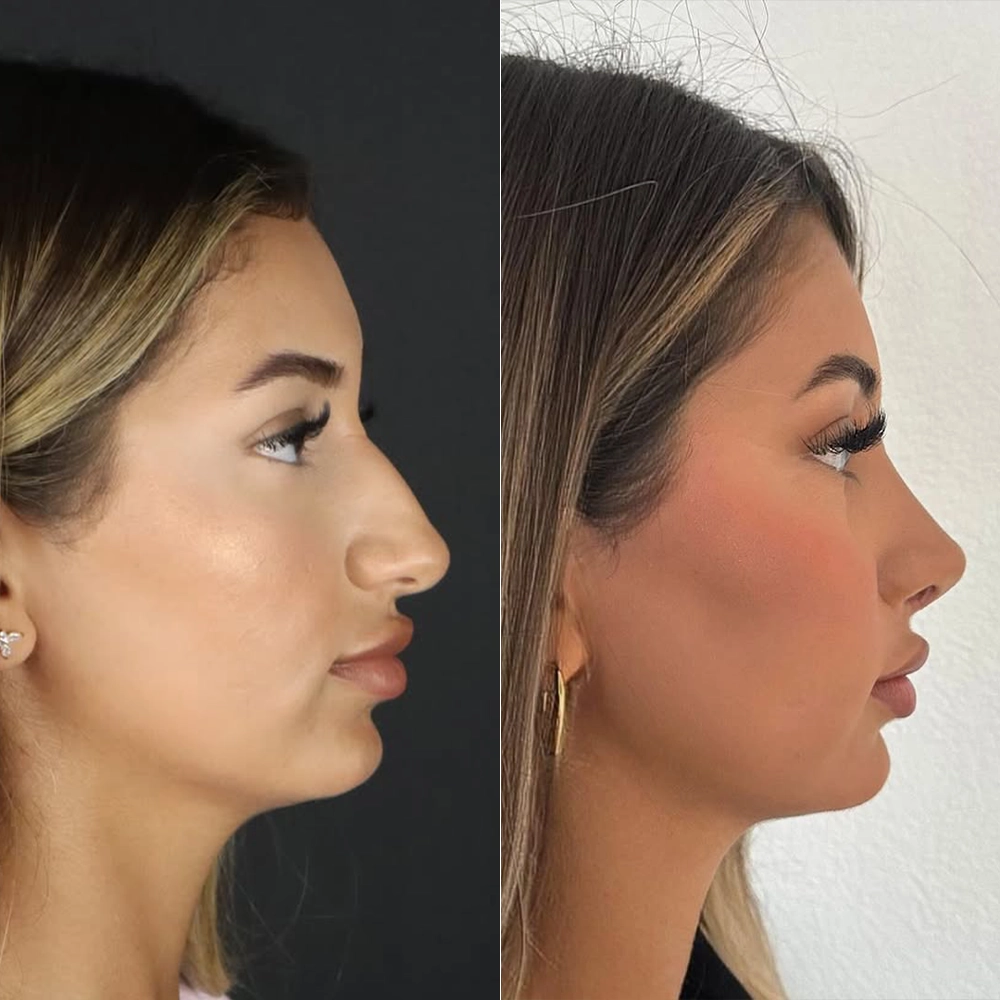 before after5