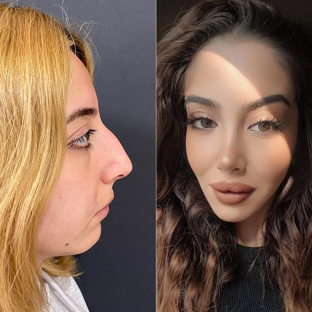 before after7