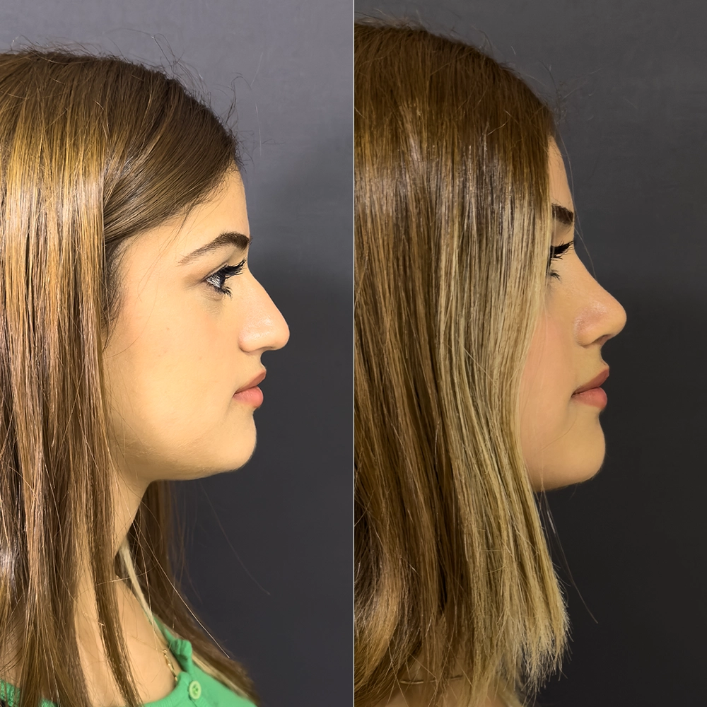 before after8