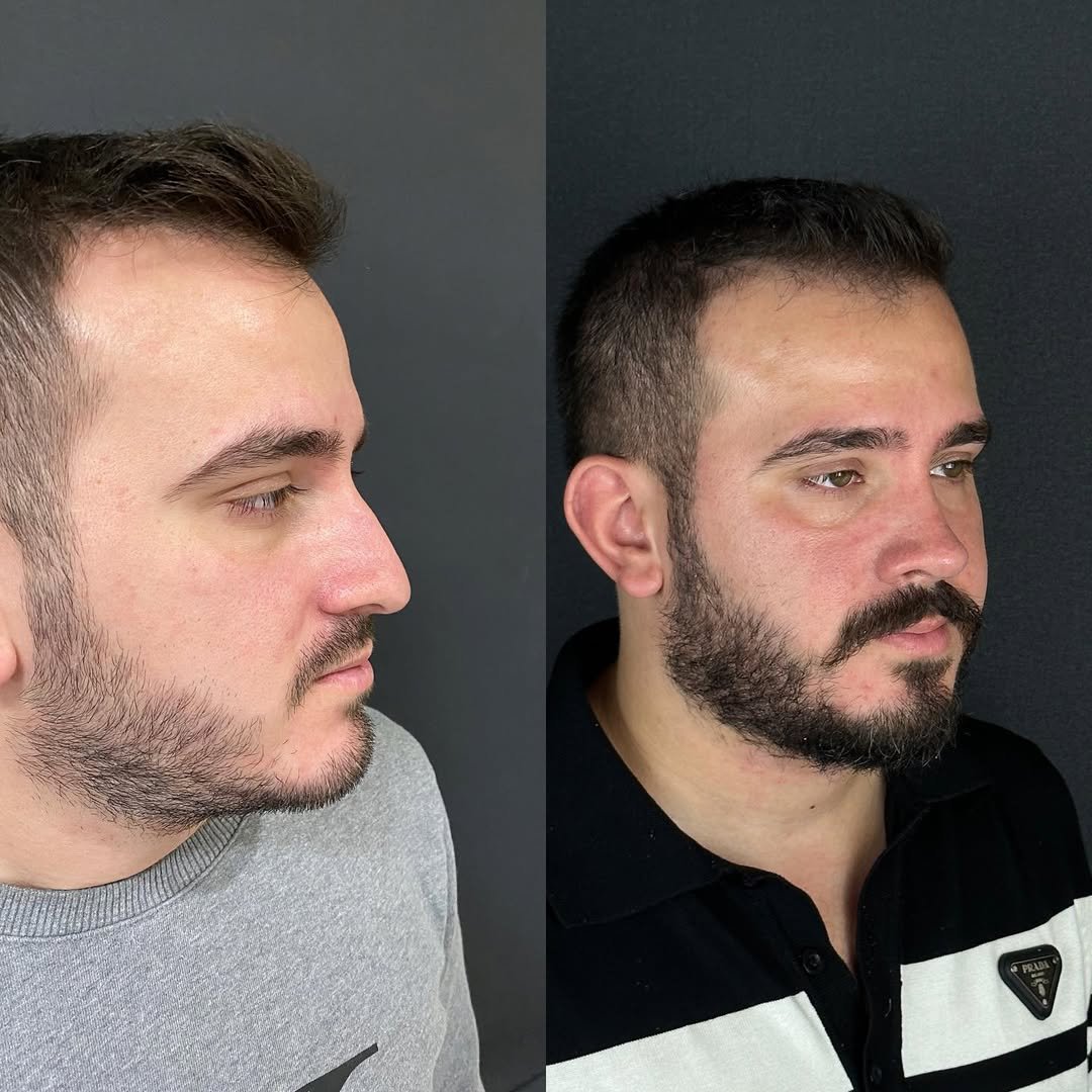 male-rhinoplasty-after-results