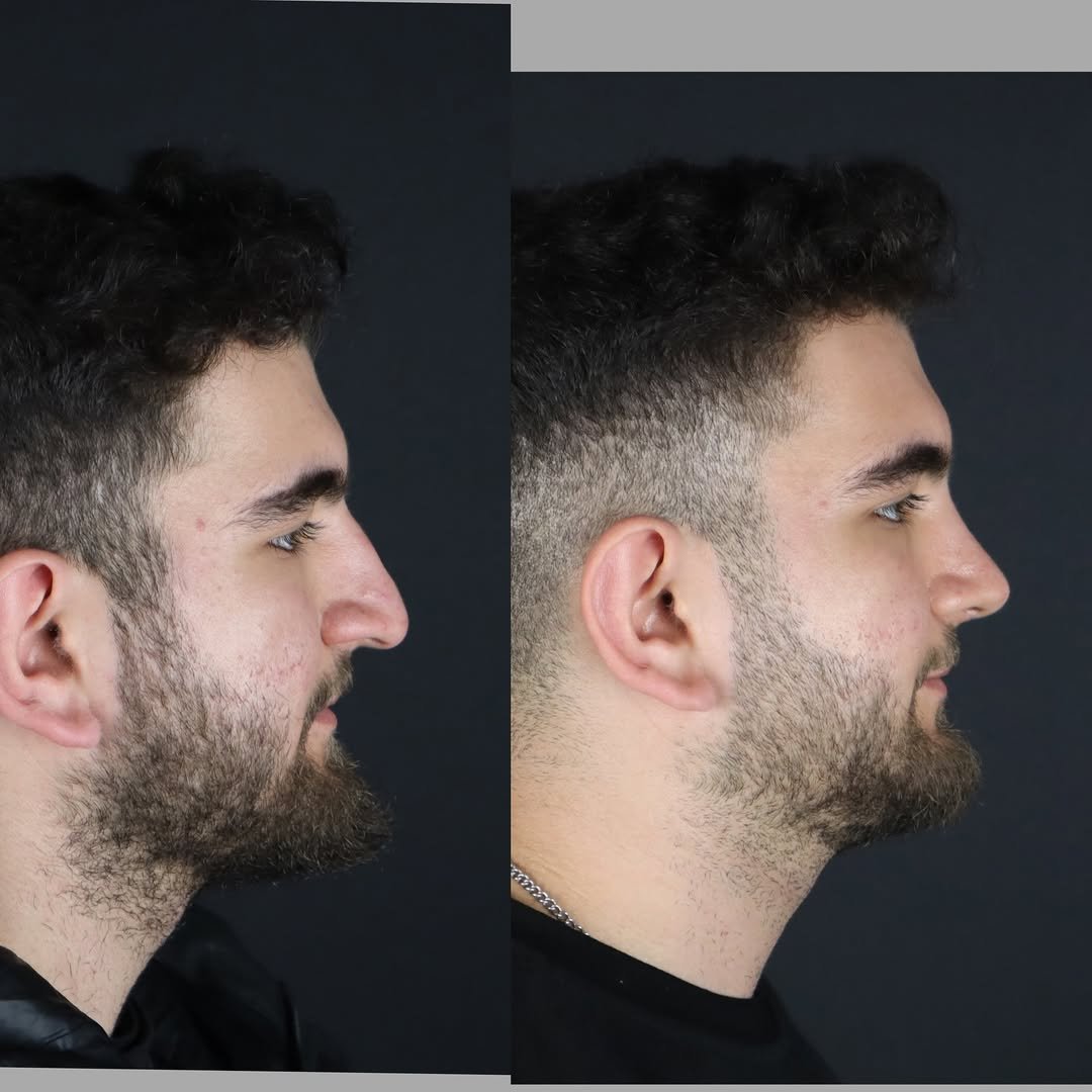 male-rhinoplasty-before-after