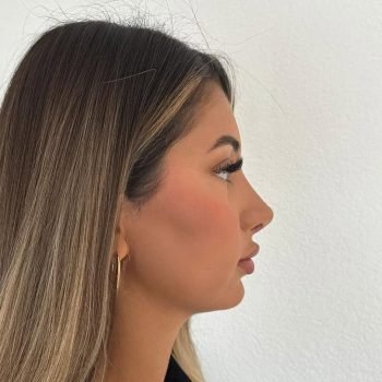 1st month control after rhinoplasty from Germany