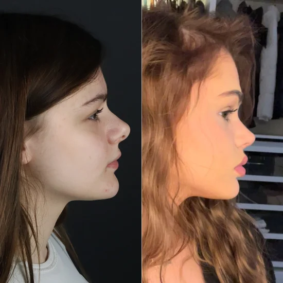 before after2