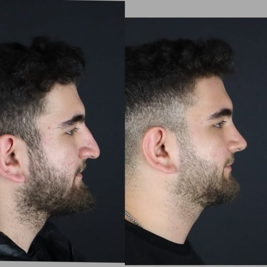 male-rhinoplasty-before-after