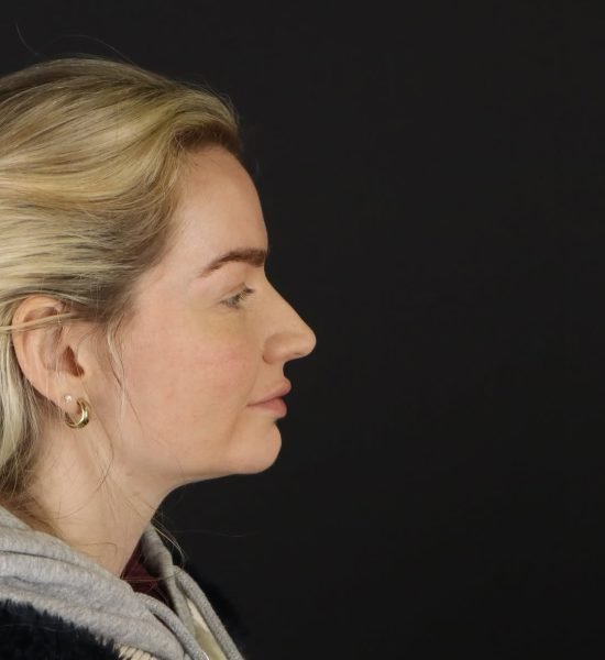 rhinoplasty-long-term-results (1)