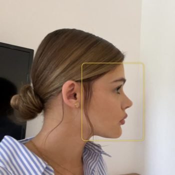 rhinoplasty-results-umman-tunc