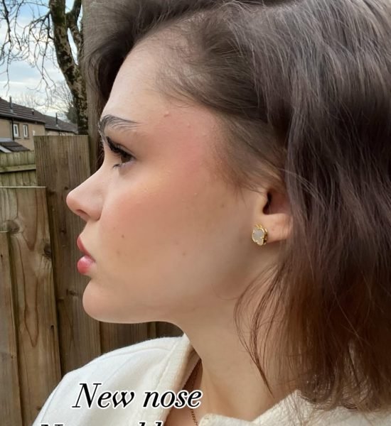 rhinoplasty-surgery-after