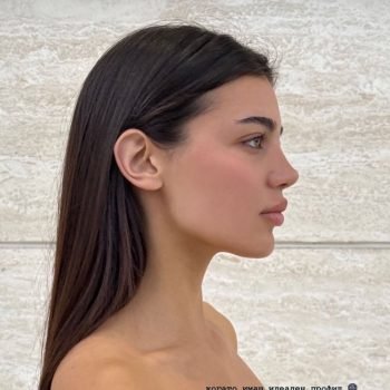 umman-tunc-rhinoplasty-results